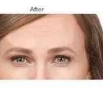Botox Before & After Patient #716