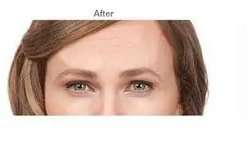 Botox Before & After Patient #716