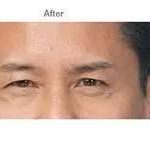 Botox Before & After Patient #719