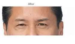 Botox Before & After Patient #719
