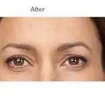 Botox Before & After Patient #722