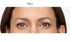 Botox Before & After Patient #722