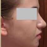 Rhinoplasty Before & After Patient #75