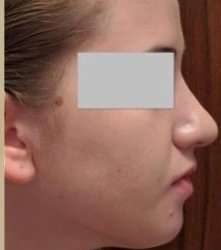 Rhinoplasty Before & After Patient #75