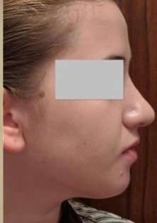 Rhinoplasty Before & After Patient #75