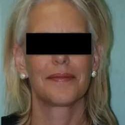 Face Neck Lift Before & After Patient #137