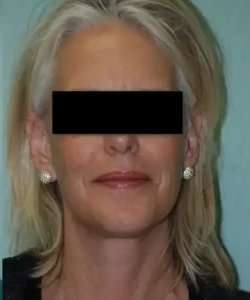 Face Neck Lift Before & After Patient #137