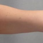 Smartlipo Vaser Lipo Before & After Patient #478