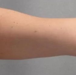 Smartlipo Vaser Lipo Before & After Patient #478
