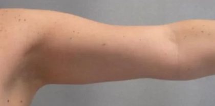 Smartlipo Vaser Lipo Before & After Patient #478