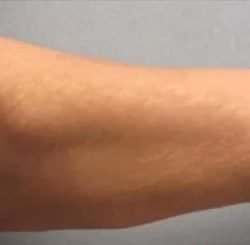 Smartlipo Vaser Lipo Before & After Patient #483