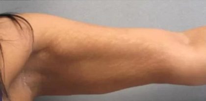 Smartlipo Vaser Lipo Before & After Patient #483