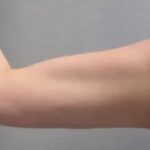 Smartlipo Vaser Lipo Before & After Patient #486