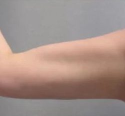 Smartlipo Vaser Lipo Before & After Patient #486