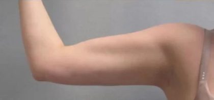 Smartlipo Vaser Lipo Before & After Patient #486