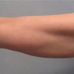 Smartlipo Vaser Lipo Before & After Patient #491