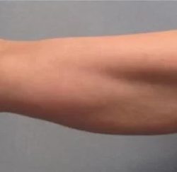 Smartlipo Vaser Lipo Before & After Patient #491