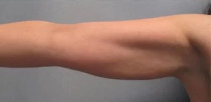 Smartlipo Vaser Lipo Before & After Patient #491