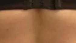 Smartlipo Vaser Lipo Before & After Patient #564