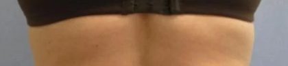 Smartlipo Vaser Lipo Before & After Patient #564