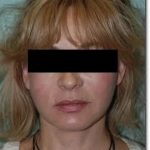 Face Neck Lift Before & After Patient #140