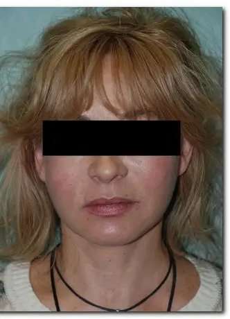 Face Neck Lift Before & After Patient #140