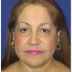 Face Neck Lift Before & After Patient #143