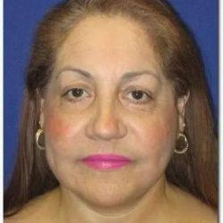 Face Neck Lift Before & After Patient #143