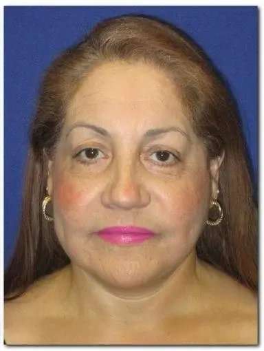 Face Neck Lift Before & After Patient #143