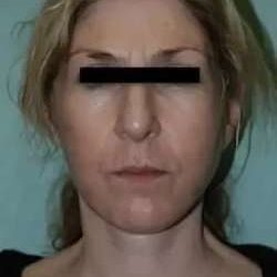 Face Neck Lift Before & After Patient #146