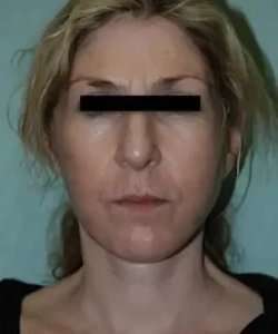 Face Neck Lift Before & After Patient #146