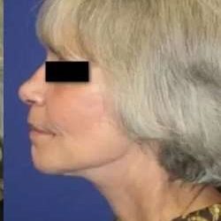 Face Neck Lift Before & After Patient #149