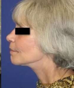 Face Neck Lift Before & After Patient #149