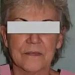 Face Neck Lift Before & After Patient #152