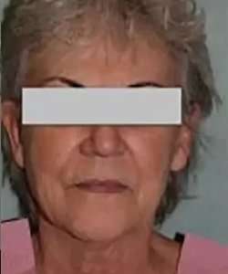 Face Neck Lift Before & After Patient #152