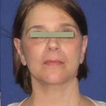 Face Neck Lift Before & After Patient #155