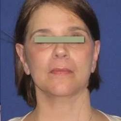Face Neck Lift Before & After Patient #155