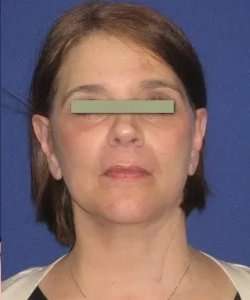 Face Neck Lift Before & After Patient #155