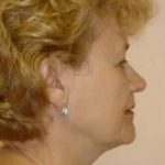 Face Neck Lift Before & After Patient #158