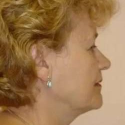 Face Neck Lift Before & After Patient #158