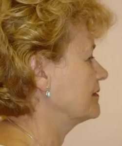 Face Neck Lift Before & After Patient #158