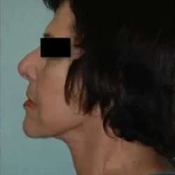 Face Neck Lift Before & After Patient #161
