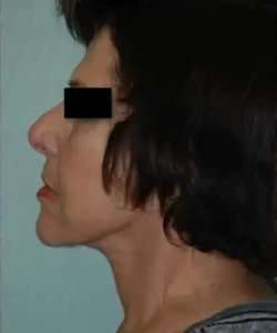 Face Neck Lift Before & After Patient #161