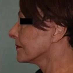 Face Neck Lift Before & After Patient #164