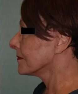 Face Neck Lift Before & After Patient #164
