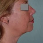Face Neck Lift Before & After Patient #167