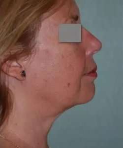Face Neck Lift Before & After Patient #167