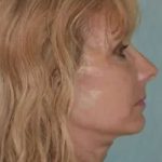 Face Neck Lift Before & After Patient #170