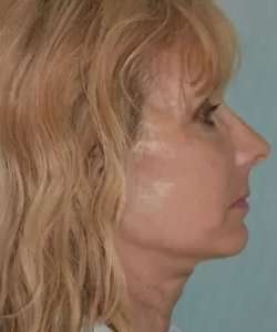 Face Neck Lift Before & After Patient #170