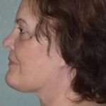 Face Neck Lift Before & After Patient #173